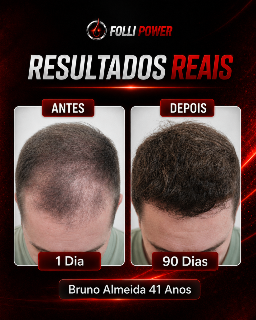 Antes e depois do cliente Bruno Almeida, 41 anos