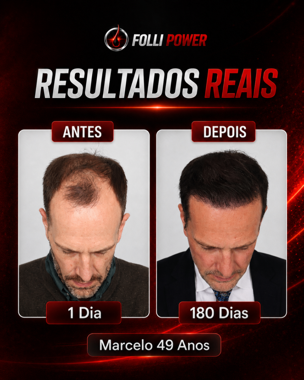 Antes e depois do cliente Marcelo, 49 anos